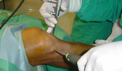 A French Minimal Access Surgery Technique in Orthopaedics was Introduced in Cuba